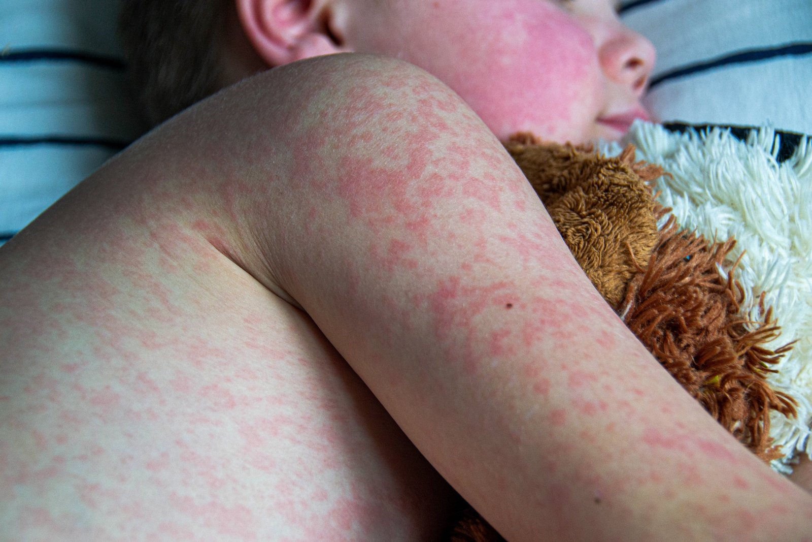 Measles is far more than a routine childhood illness